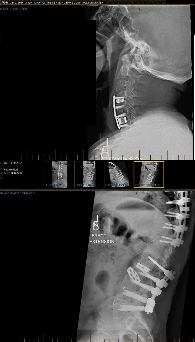 Ford Ranger My Ranger Raptor is finally on the way...or so they say... 2-2024 Spine X-Rays 28 Screws